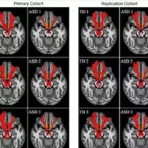 自閉癥原因最新研究：中腦邊緣獎(jiǎng)賞通路損傷與社交障礙